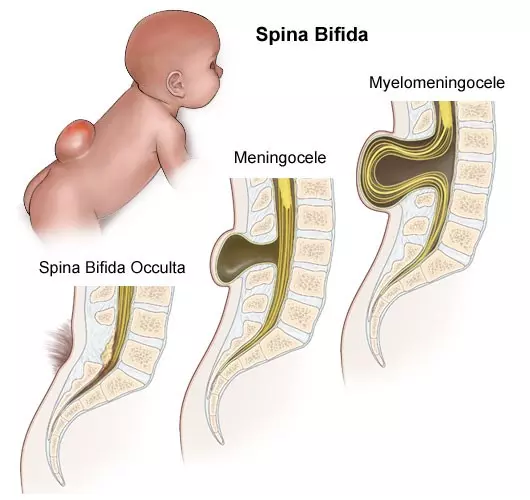 <ul><li><p>herniation of SC &amp; nerve roots </p></li><li><p>vertebral defect </p></li></ul>
