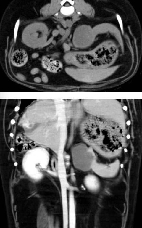 <p>make up 45-51% of canine splenic malignancies</p><p>8.7% chance of concurrent right atrial masses</p>