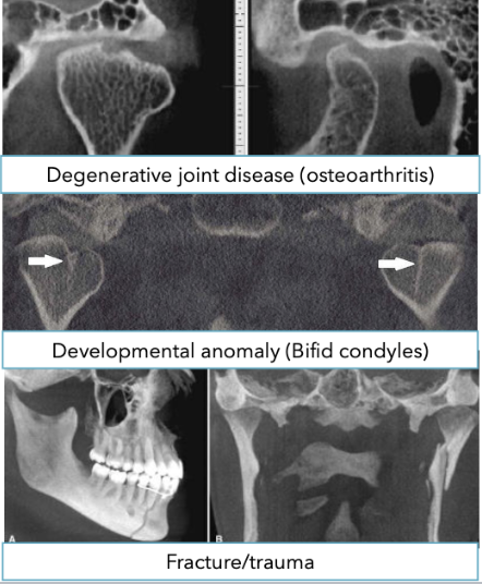 <p>Be in occlusion. Open-mouth CBCT has limited impact on TMD diagnosis and management </p>