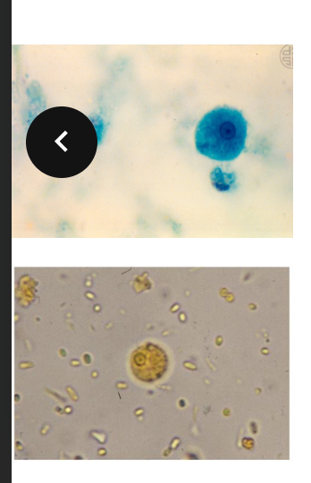 <p>Epidemiology - similar to E. histolytica.</p><p>E. Hartmanni is non-pathogenic unlike E. Histolytica</p><p>Difference lies in the sizes of the respective organisms. Trophozoites measure less than 12 microns, while cysts will measure less than 10 microns.</p>