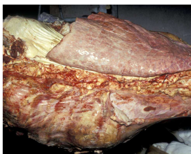 <ol><li><p><strong>Species/specimen- </strong>bovine lungs- noted by divisions (lobes) in lung parenchyma</p></li><li><p><strong>Describe this bovine lung using 3 words- </strong>enlarged, lesions concentrated dorsally (2/3rds of cranial and caudal lobes), yellow (bottom of the image)</p></li><li><p><strong>Potential diagnosis- </strong>abscess or tumor- palpate to distinguish</p><ol><li><p>Lung/mediastinal abscess- single walled-off abscess should be judged on its size and feel alone</p><ol><li><p>Encapsulated on palpating</p></li><li><p>Do not open on the line</p></li><li><p><strong>Judgement</strong>- local rejection</p></li></ol></li><li><p>Tumor- unlikely to see tumor this size in cattle lungs</p><ol><li><p>Usually very localized</p></li><li><p>Randomly shaped on palpating</p></li></ol></li></ol></li><li><p><strong>Judgement- </strong>local rejection</p></li></ol><p></p><p>Extra notes:</p><ol><li><p>Chronic suppuration pneumonia- most commonly seen cattle pneumonia</p><ol><li><p>Affected cranioventral parts of the lung are usually pale with distended airways</p></li><li><p>Cut surfaces filled with white mucous</p></li><li><p>Common condition in older cows</p></li><li><p>Judgement- local rejection</p></li><li><p>Check for more active focus of pneumonia in caudal lung</p></li></ol></li></ol><p></p>