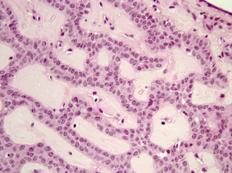 <p>Patient de 70 ans, lésion de la lèvre supérieure</p><p>1) Diagnostic </p><p>2) Epidémiologie (localisation, âge, pronostique) </p><p>3) Histologie</p><p>4) IHC </p><p></p>