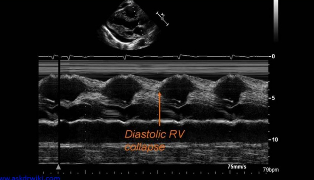 <p>Most important cardiac structure that should be evaluated with suspected tamponade </p>