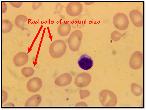 Anisocytosis