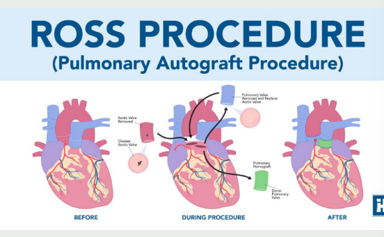 <p>Pulmonary valve</p><p>transplant to aortic</p><p>position, reimplantation</p><p>of the coronary arteries,</p><p>and placement of a</p><p>homograft in pulmonary</p><p>position</p>