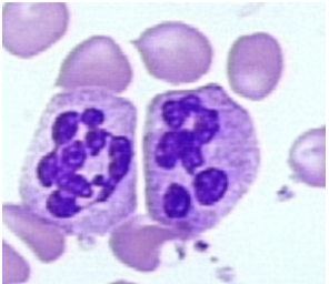 <p>what nuclear abnormality is associated with the following:</p><ul><li><p>chronic infections</p></li><li><p>megaloblastic anemia</p></li><li><p>drugs</p></li></ul><p></p>