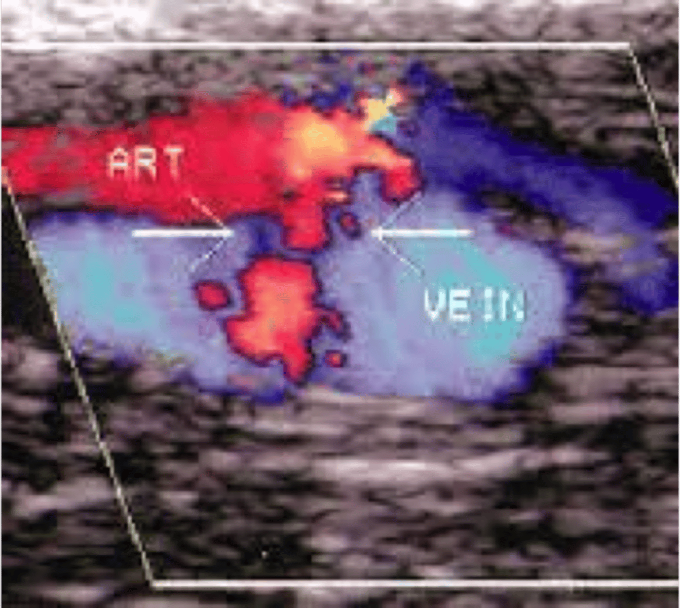 <p>type of vascular access for dialysis; created by surgically connecting an artery to a vein</p>