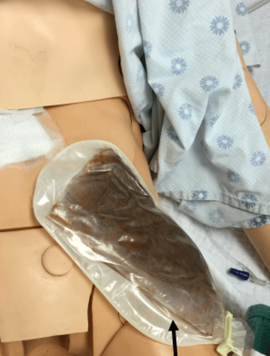 <p>- surgical opening created to allow elimination of feces</p><p>- external collection bag</p><p>- be aware pt. has it and consider gait belt position</p>
