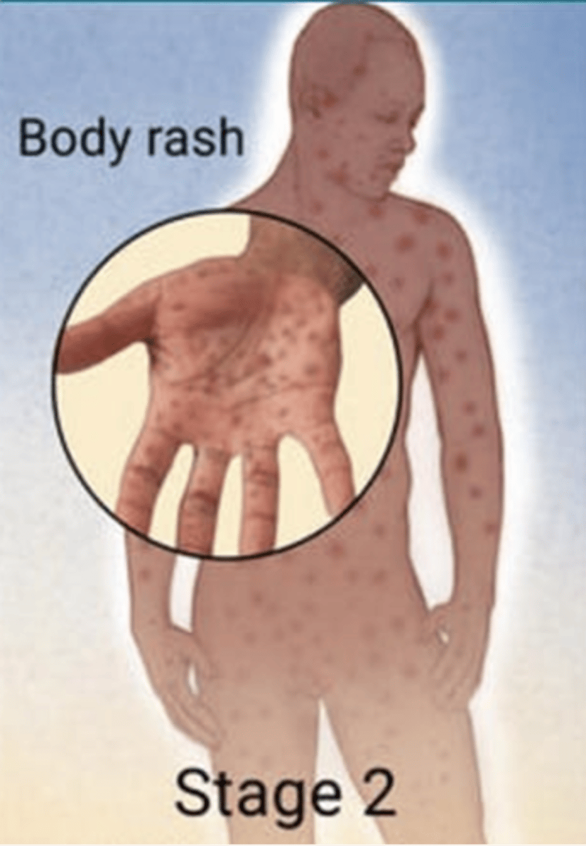 <p>2 weeks to 6 months after initial infection</p><p>Systemic infection from homogenous spread</p><p>Viral syndrome</p><p>Rash: Diffuse, B/L papulosquamous lesions involving the palm, soles, and other skin surfaces</p><p>Other possible symptoms: pharyngitis, hepatitis, alopecia</p>