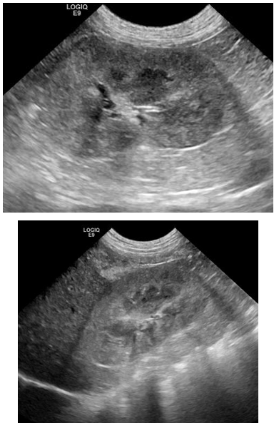 <p>Changes are non-specific and often bilateral</p><p>Heterogenous corticies</p><p>Reduced cortico-medullary definition</p><p>Indentations suggest old infarcts</p>