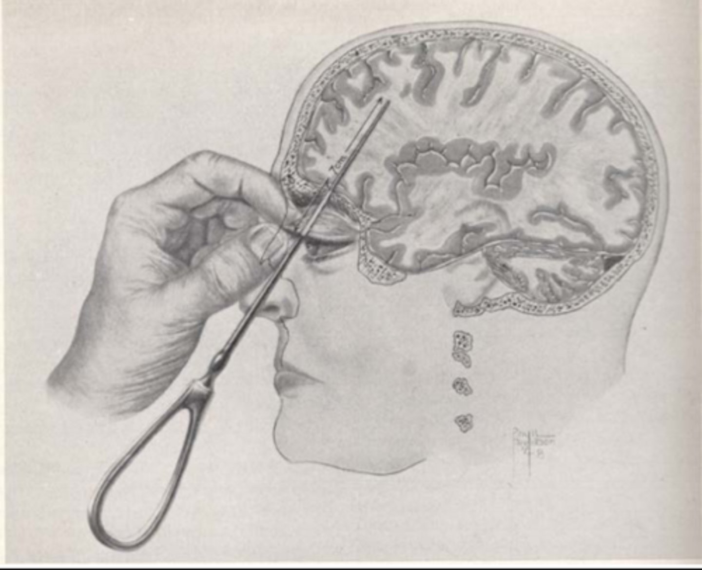 <p>Surgical procedure severing the connection between the prefrontal cortex and the rest of the brain.</p><p>Reasoning for procedure was that this area was somehow malformed or damaged, and if the nerves were severed they might regenerate into new, healthy connections.</p><p>The main indications for this procedure included severe chronic anxiety, depression with risk of suicide, incapacitating obsessive-compulsive disorder and high levels of aggression.</p>