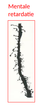 <ul><li><p>onderzoek van hersenen van kinderen met mentale retardatie</p><ul><li><p>macroscopie: geen afwijkingen</p></li><li><p>microscopie (// fetale hersenen aspect):</p><ul><li><p>minder dendritic spines</p></li><li><p>dendritic spines zijn dunner &amp; langer</p></li></ul></li></ul></li></ul><p>→ conclusie: bij mentale retardatie is er een onderliggend probleem van synapsvorming</p><p>→ geen normale vorming van neuronale circuits</p><p></p>