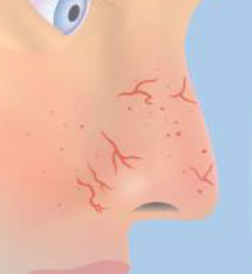 <p>dialated small blood vessels near skin surface </p>