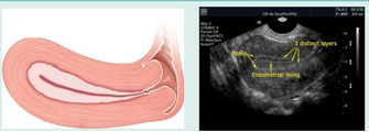 <p>what uterine phase is this (and endometrial thickness)?</p>