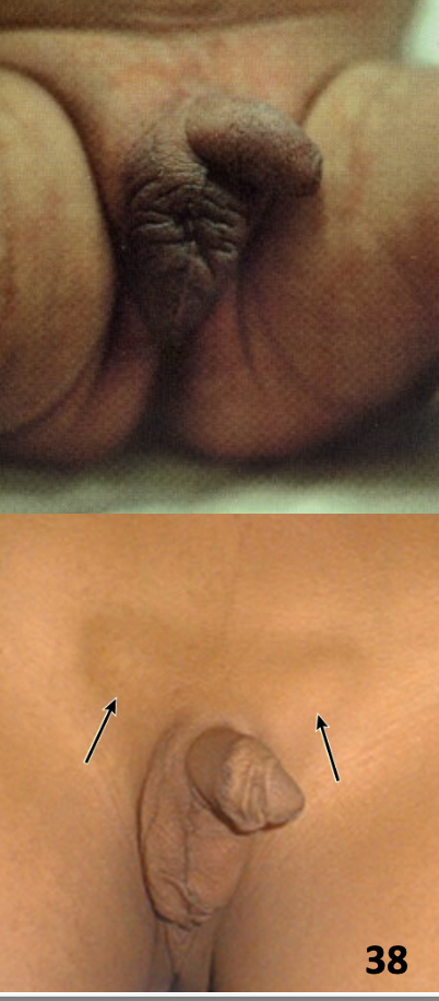 <p>diagnosis of Cryptorchidism</p>