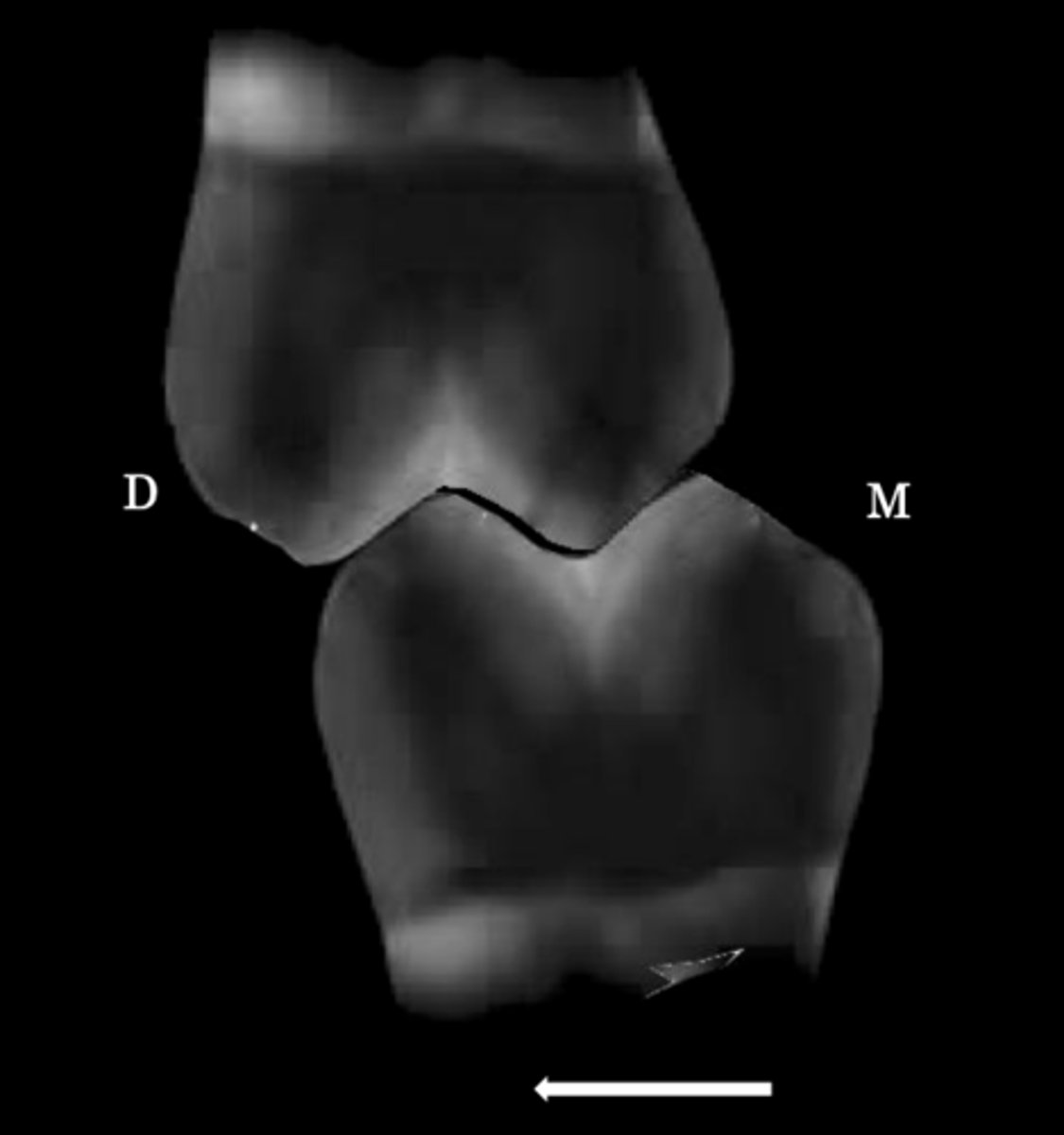 <p>This type of interference you see when CR and MIP are not coincident</p><p>Usually found at mesial incline of maxillary cusps against distal incline mandibular cusps</p>
