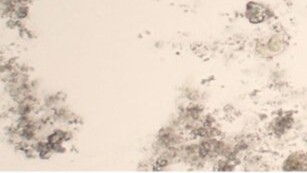 <p>Granular appearance<br>Many small dots in one area</p>