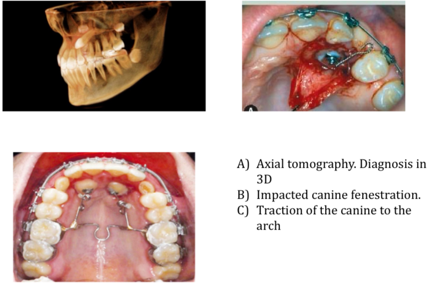 <p><span>Diagnose with axial tomography, Ortho, x ray</span></p><p><span>Early treatment to prevent lateral incisor root resorption</span></p>