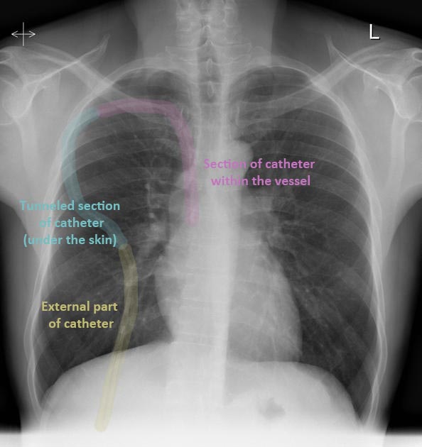 <p>Long-term therapies like chemotherapy or parenteral nutrition. (image shows hickman line)</p>