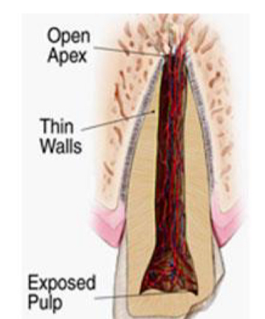<p>Thin dentinal walls</p><p>Susceptible to fracture during apexification</p><p>Short roots&nbsp;</p><p>Unfavourable corono-radicular ratio</p><p>No apical stop for obturation</p>