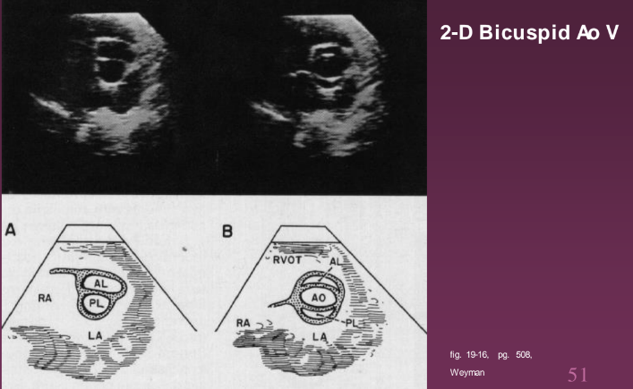 <p>Best view is in the parasternal SAX, with careful TX position. Cineloop the SAX to view how the aortic valve opens. Systolic doming in LAX and eccentric closure in LAX.</p>