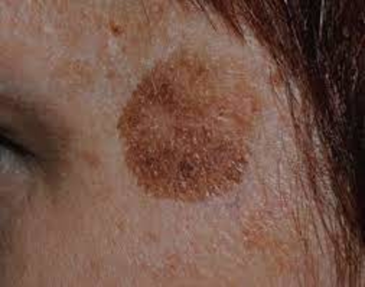 <p>-Flat, circumscribed area that is a change in color of the skin</p><p>-Less than 1 cm</p><p>Examples:</p><p>-Moles (nevi)</p><p>-Freckles</p><p>-Scarlet's fever (erythematous macules)</p><p>-Mesales</p>