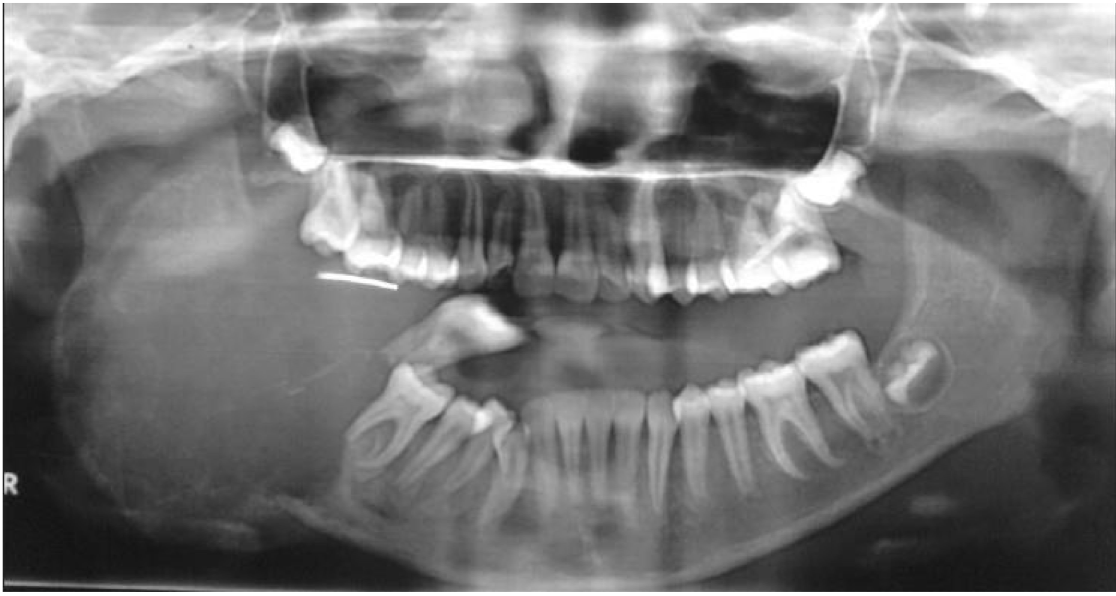 <p>A 18 year old boy presented with cystic swelling of mandible. Provide DD and justify</p>