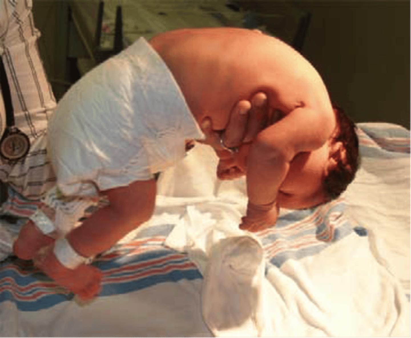 <p>Condition with decreased muscle tone in an infant, with the infant being unresponsive.</p>