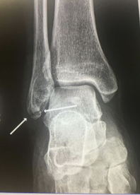 <p>What type of fracture is this?</p>