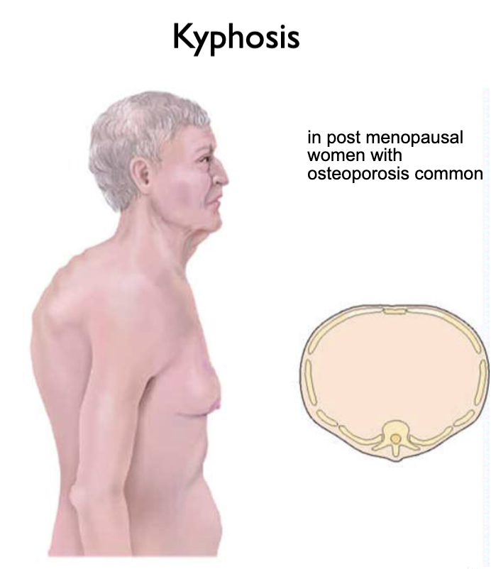 <p>abnormal, common in post-menopausal women with osteoporosis </p>