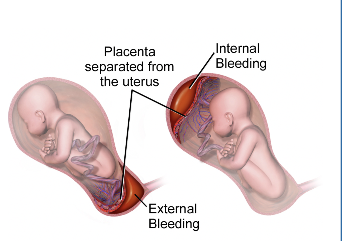 <ul><li><p>placenta detaches from the uterus before delivery </p></li><li><p>causes extreme pain, think of an organ becoming completely detach from you </p></li><li><p>bleeding </p></li><li><p>rigid board like abdomen </p></li></ul><p></p>