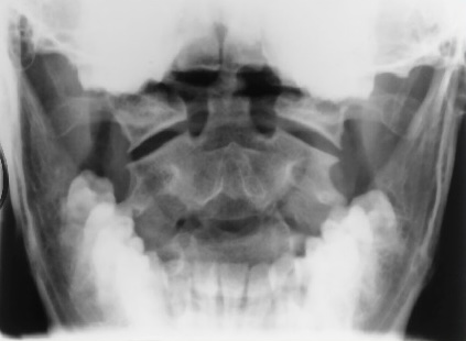 <p>What is this x-ray demonstrating?</p>