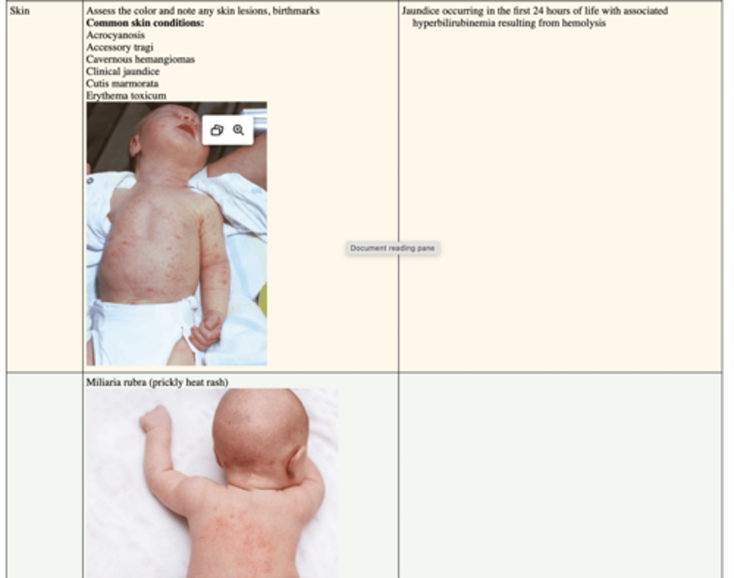 <p>Nevus simplex, nevus flammeus</p><p>Sturge-Weber Port Wine nevi</p><p>Transient neonatal pustular melanosis</p><p>Assess skin turgor</p>