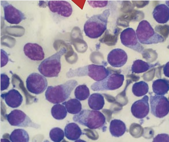 <p>Lymph node cytology</p><p>Enlarged lymph nodes - disease</p><p>What is this?</p>