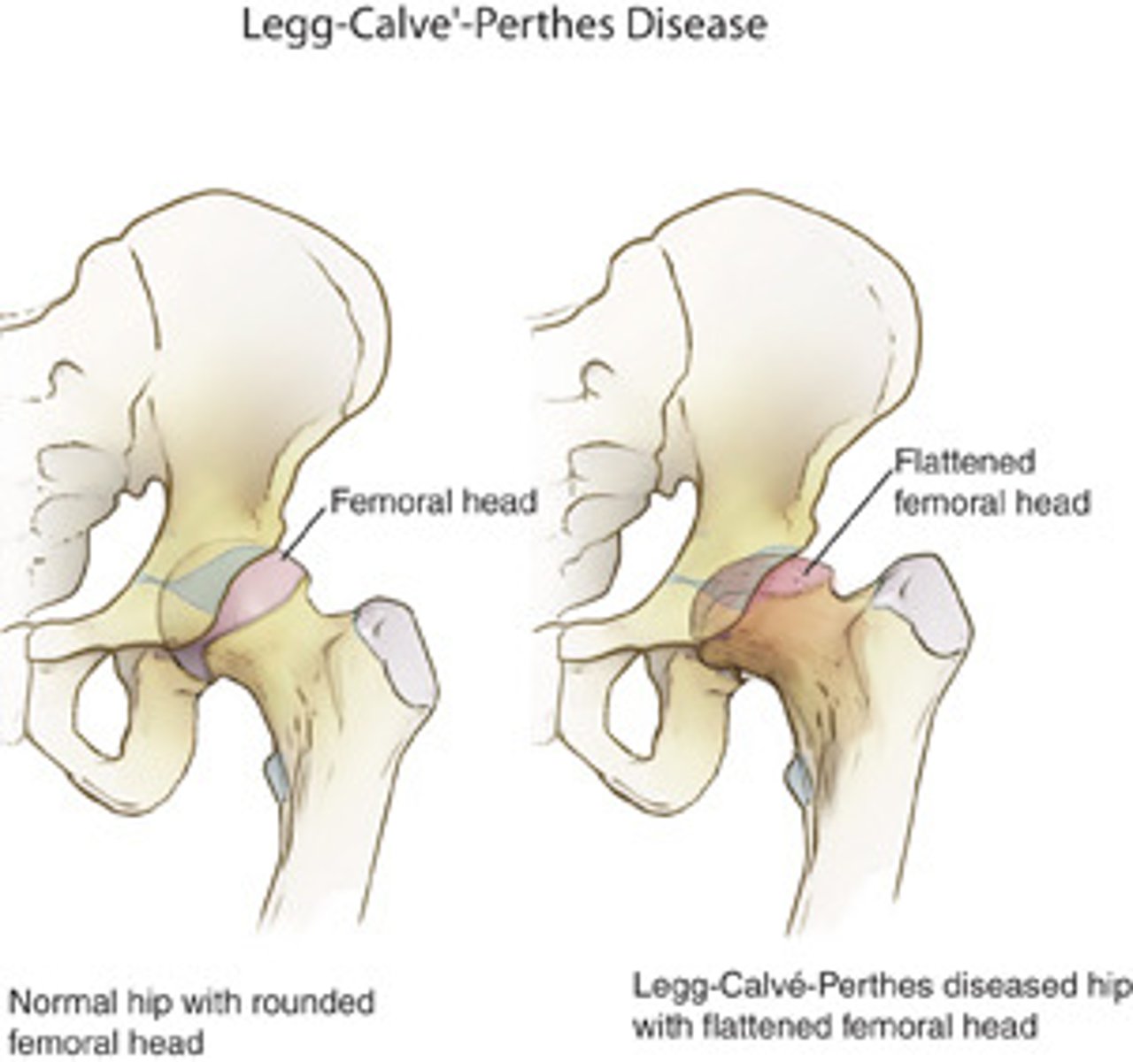 <p>Legg-calves-perthes → AVN of femoral head</p>
