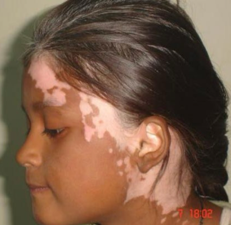 <p>what type of color change and condition is depicted</p>