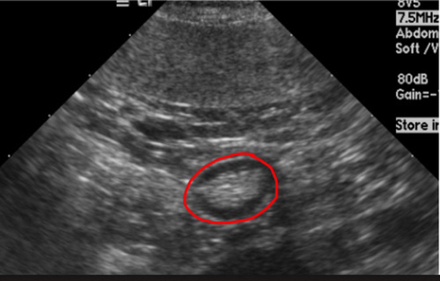 <p>this is a short axis view of the colon or small intestine?</p>