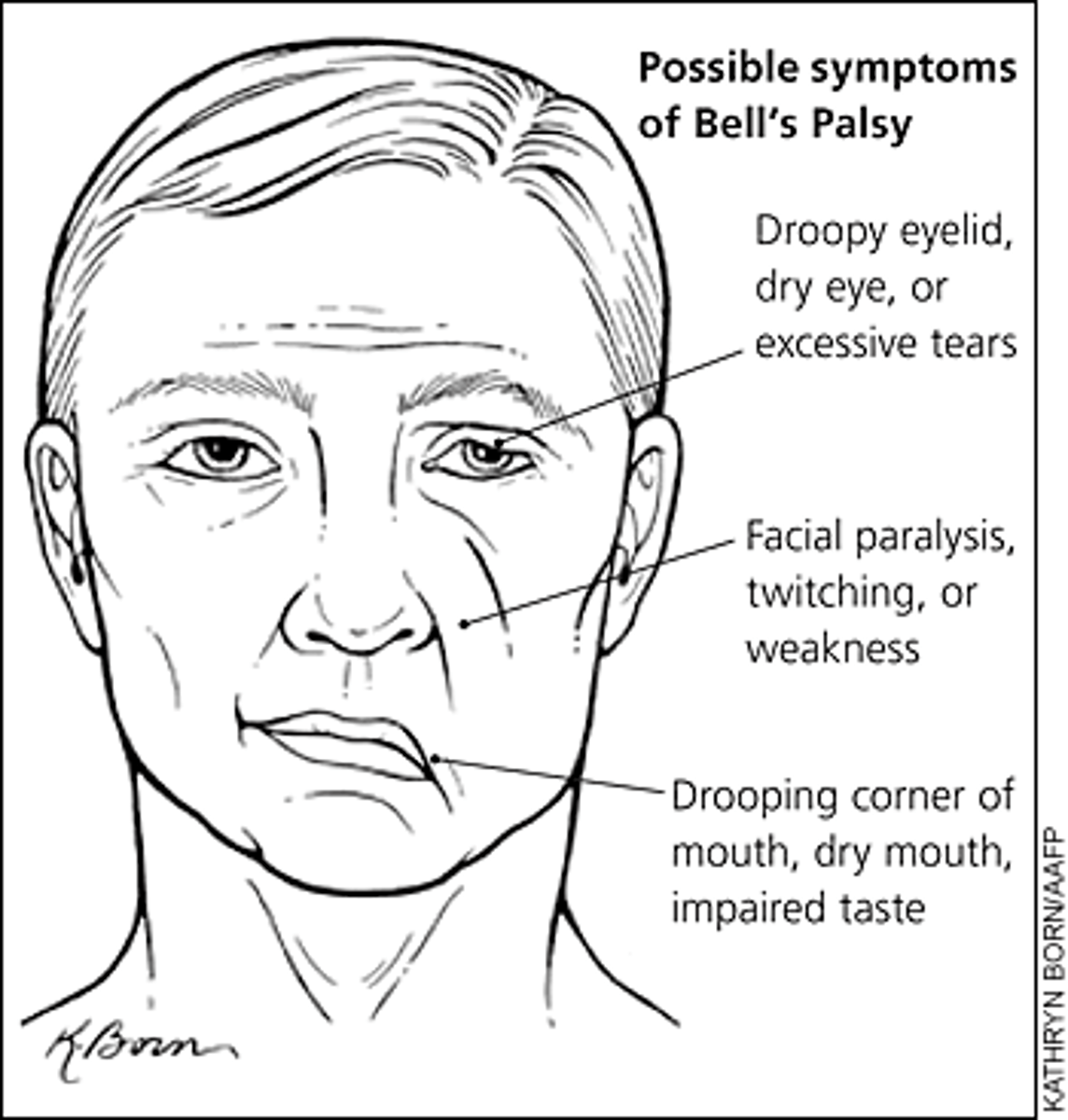 <p>1. cerebral palsy= partial paralysis, lack of muscle, coordination, due to lack of oxygen getting to the brain</p><p>2. Bell's palsy= paralysis on one side of the face</p>