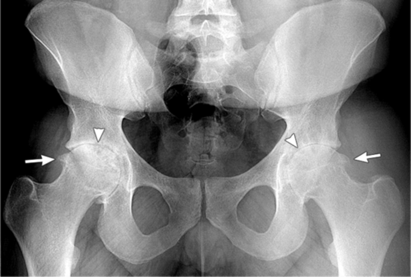 <p>The radiographic features here are consistent with which process?</p>