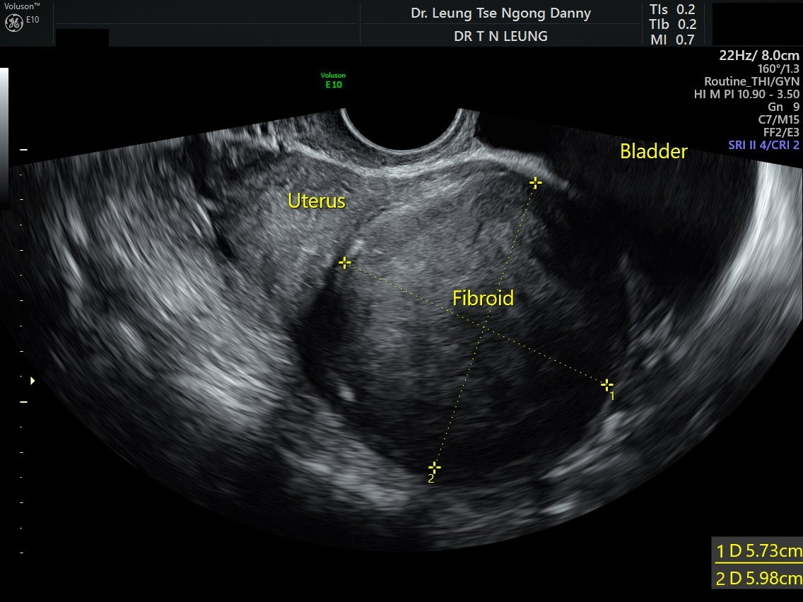 <p><strong><mark data-color="yellow" style="background-color: yellow; color: inherit;"><u>MC uterine pelvic tumor</u></mark></strong></p><ul><li><p>&gt; 30 yrs</p></li><li><p>Black women</p></li><li><p><strong>estrogen-dependent</strong></p><ul><li><p>pelvic pain</p></li><li><p>pain</p></li><li><p>heavy or irregular bleeding</p></li></ul></li></ul><p></p>