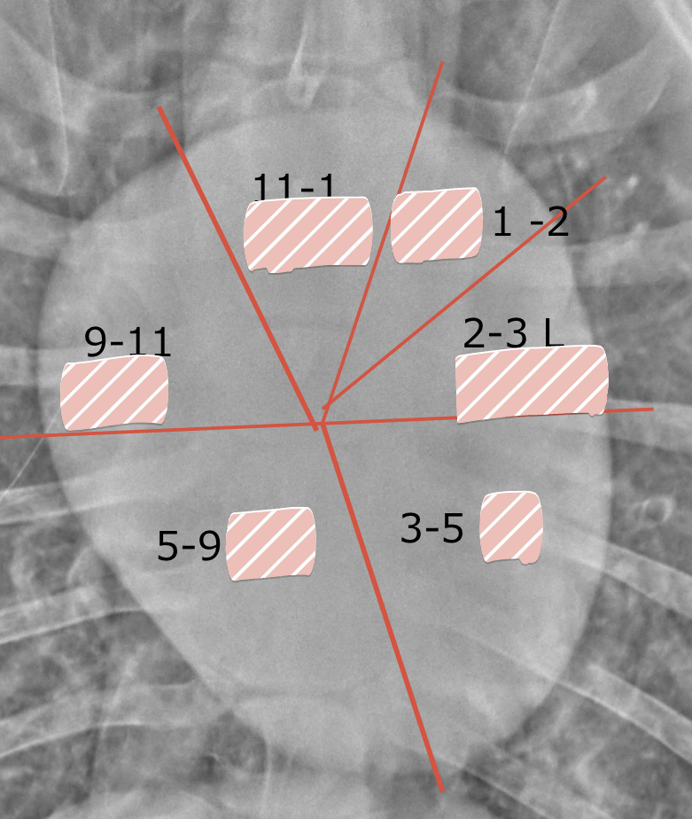 <p>Where is the left ventricle</p>