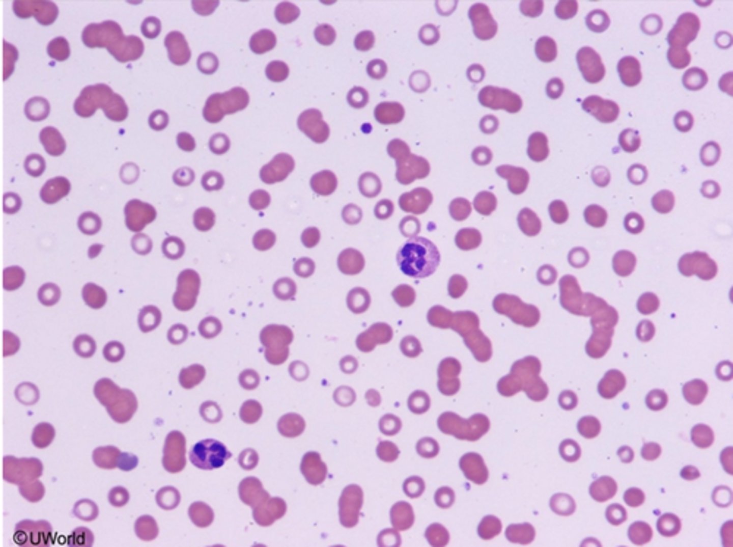 <p>a finding seen with elevated serum protein</p>