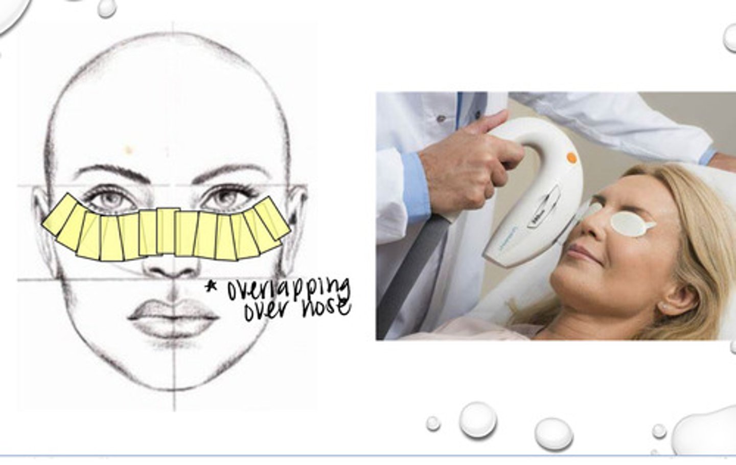 <p>How do we use intense pulse light in optometric field?</p>