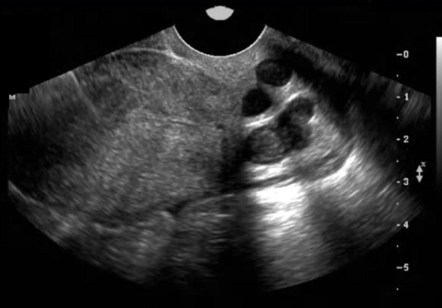 <p>a pt has hx of <strong>nabothian</strong> cyst. where will you scan for this</p><p>.</p><p>a) cervix</p><p>b) endometrium</p><p>c) vaginal canal</p><p>d) ovary</p>