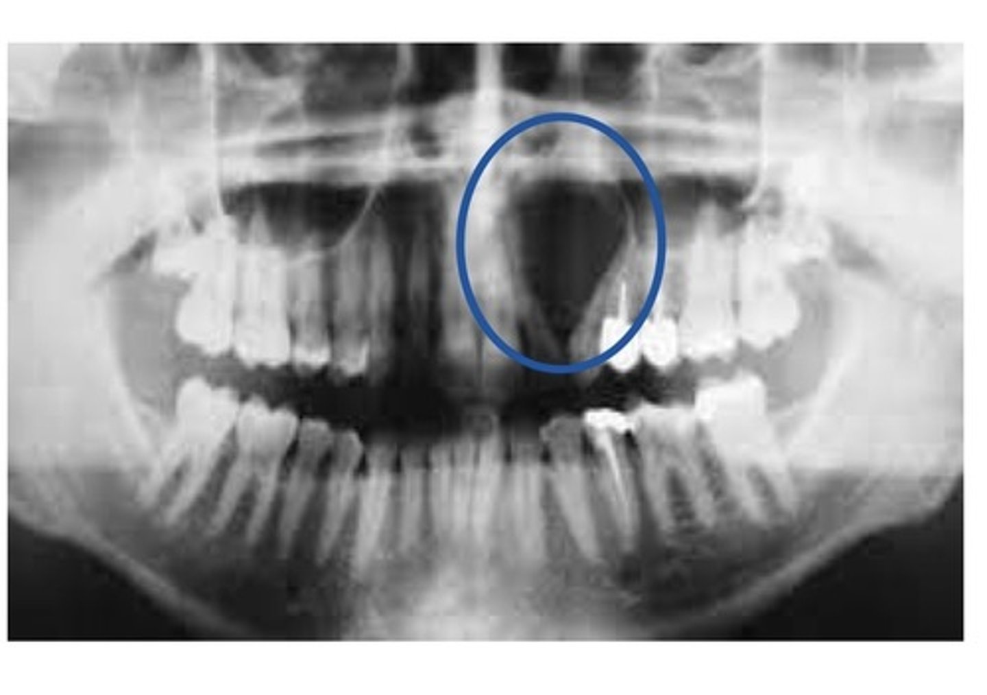 <p>A well defined, pear-shaped radiolucency located between the roots of the maxillary lateral incisor and cuspid. Tx: surgical removal. Pokes into sinuses and may cause a salty taste or infection.</p>