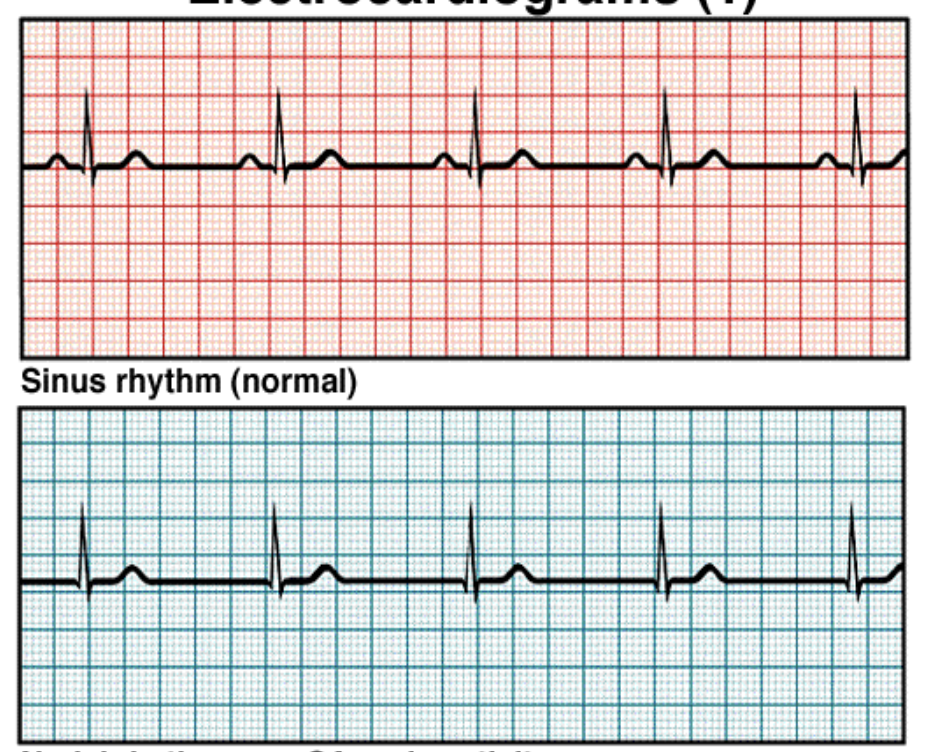 <p>What is happening in the lower EKG?</p><p>A. No atrial contraction</p><p>B. No ventricle depolarization</p><p>C. No ventricle contraction</p><p>D. No AV node activity</p>