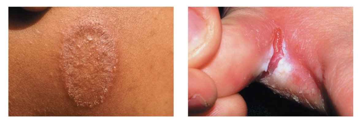 <ul><li><p>fungal skin disease</p></li><li><p>cause: <em>Tinea</em> species (ex. <em>Tinea corporis</em> = ringworm of the body)</p><ul><li><p><em>T. pedis</em> may lead to a secondary bacterial infection</p></li></ul></li><li><p>transmission: direct contact (person/animal to person); indirect (fomite)</p></li><li><p>treatment: antifungal drugs</p></li></ul><p></p>