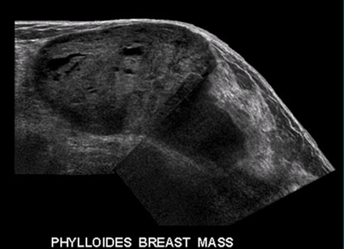 <p><span>rare breast tumor that originates from the <u>connective tissue</u> of the breast and grows in a leaflike pattern, can be benign</span></p>