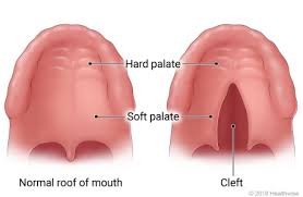 <p>a BIRTH DEFECT where the <strong>ROOF OF THE MOUTH DOESN’T FULLY CLOSE</strong></p><ul><li><p><strong>CAUSED GENETICALLY AND ENVIRONMENTALLY </strong></p></li></ul><p></p>