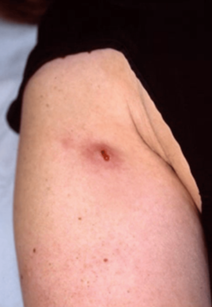 <p>wound; larvae</p>